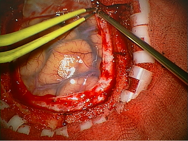 Brain surgery procedure
