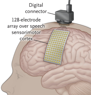 Location of sensors used for speech detection from Moses et al. 2021